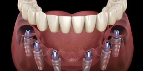 How Much Do Dental Implants Cost?