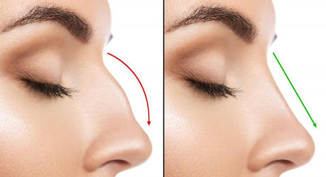 How Much Does Rhinoplasty Cost?